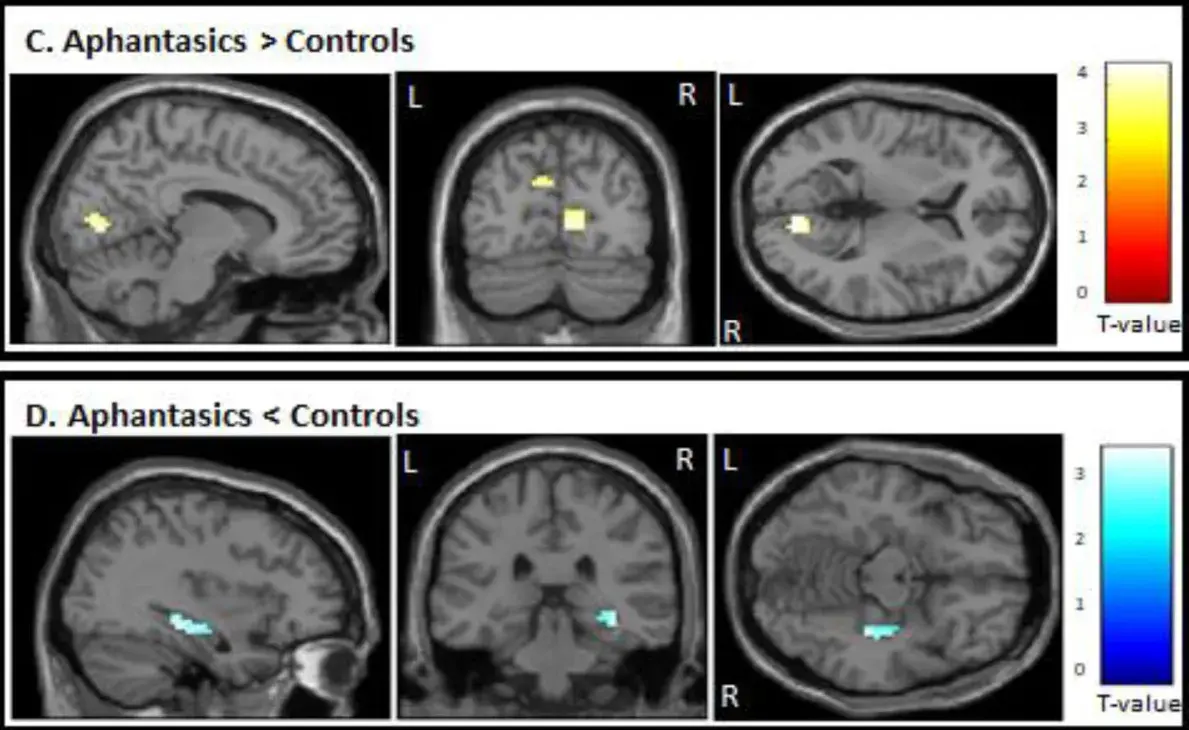 Auto-generated description: Three brain scan images display highlighted areas with contrasting activity levels, indicated by color gradients, across two different conditions labeled Aphantasics > Controls.