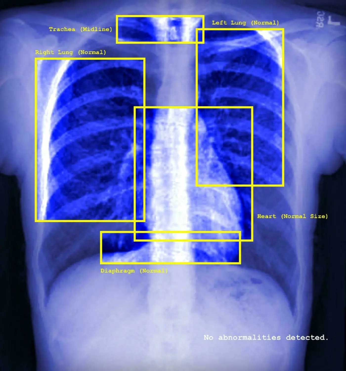 This image shows a blue xray image of a person's chest - it shows the ribs, the faint outline of a heart, and other organs. The image features yellow squares surrounding the organs (left lung, trachea, right lung, heart, diaphragm) - each of them feature labels such as: normal, midline, normal size. There is text in the right bottom corner in white which states 'no abnormalities detected'. 